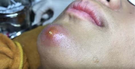 Make social videos in an instant: Super Huge Pimple On The Chin Popped - New Pimple Popping ...