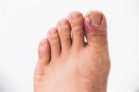 Ingrown Toenailtypes Symptoms Causes Remedies And Prevention Factdr