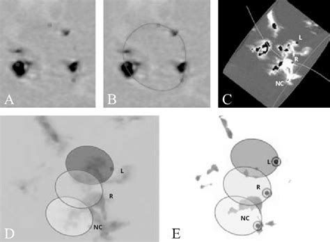 Radiological Appearance Of Aortic Annulus As Seen With Computed