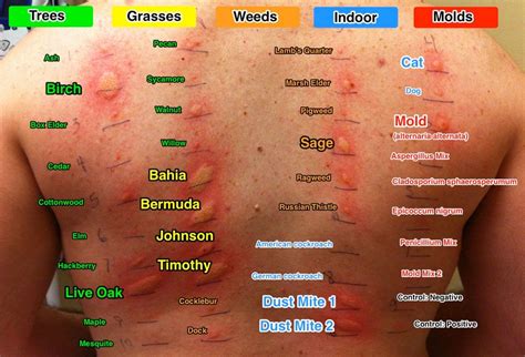 Allergy Skin Test Results Chart Naturalskins