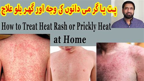 Prickly Heat Treatment Skin Rash Red Skin Rash Miliaria Rubra