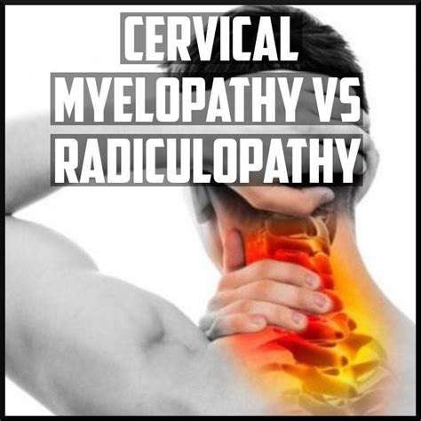 Differentiating Cervical Myelopathy From Radiculopathy Rsportsmed
