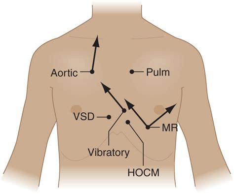 Approach To The Patient With A Heart Murmur Thoracic Key