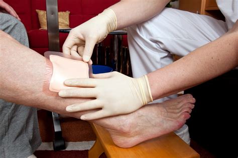 Early Varicose Vein Treatment Best For Faster Ulcer Healing Nursing Times