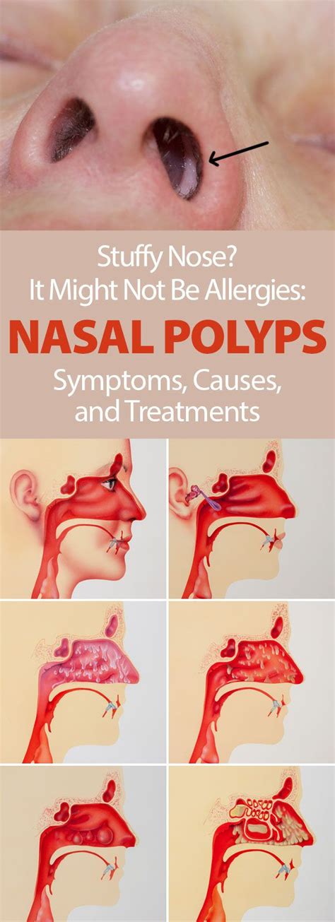 Get Rid Of Allergies And Nasal Polyps Naturally Health And Wellness