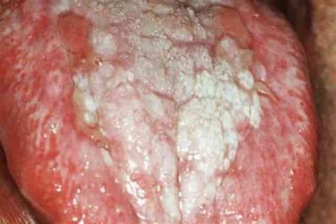 Ulcer On Tongue Tip Under Side Back Pictures Get Rid