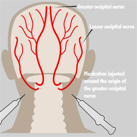 Greater Occipital Nerve Block Procedure