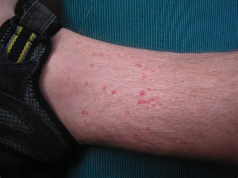 Flea Bites On Legs