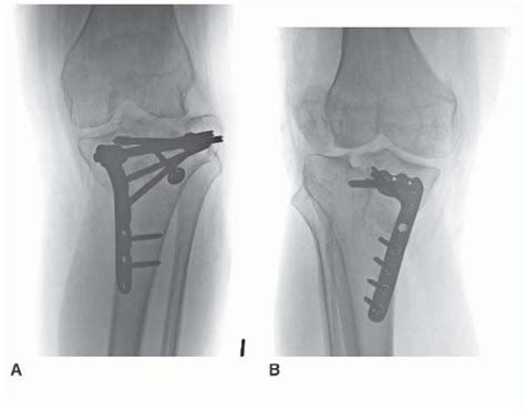 Tibial Plateau Fractures Open Reduction Internal Fixation