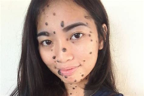 woman relentlessly bullied for mole covered face and cruelly branded a monster is now up for