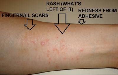 Rashes On Forearms Pictures Photos
