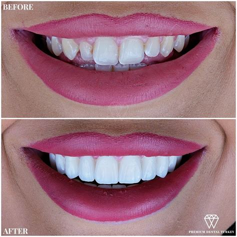 ellie scales smile makeover teeth makeover dental aesthetics beautiful teeth