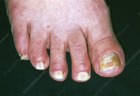 Fungal Infection Stock Image M2700196 Science Photo Library