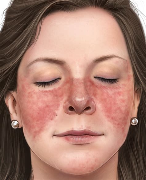Ellis Kelly Trending Lupus Skin Rash Treatment