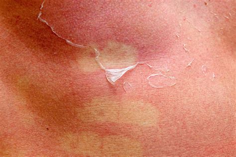 230 Sunburned Human Skin Peeled Peeling Stock Photos Pictures