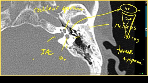 Temporal Bone Anatomy On Ct Imaging Mri Online Youtube