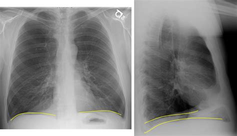 Chest Radiograph