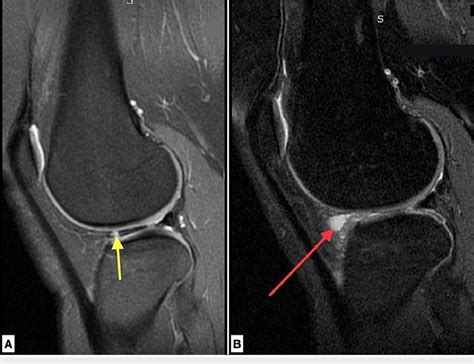 Mri Pre Op And Post Op A T Sagittal Image Of The Right Knee Of A