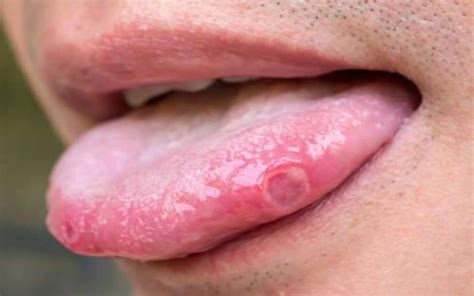 Writing on twitter, spector, who is professor spector is urging anyone who experiences lesser known symptoms, like covid tongue, to. THE COVID TONGUE