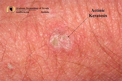 Actinic Keratosis What Is It Academic Dermatology Of Nevada