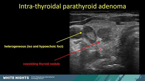 Parathyroid Ultrasound When Why And How To Do It Gerasimos Sykiotis