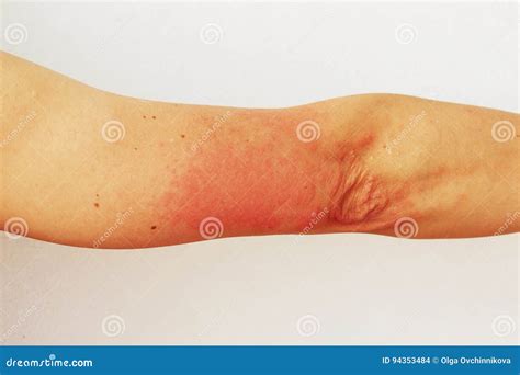 Red Pustules And Vesicles On The Skin Of The Hand As Symptoms Of