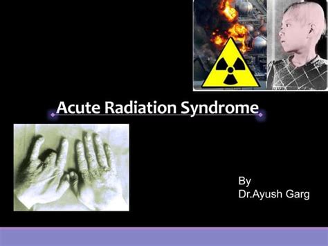 Acute Radiation Syndrome Ppt