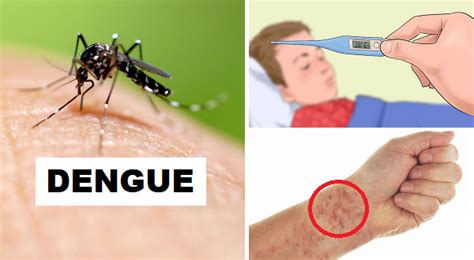 Ano Ang Sakit Na Dengue