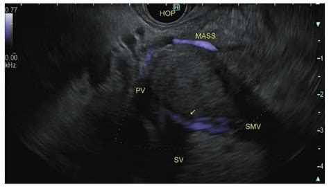 Cancers Free Full Text The Role Of Endoscopic Ultrasonography In