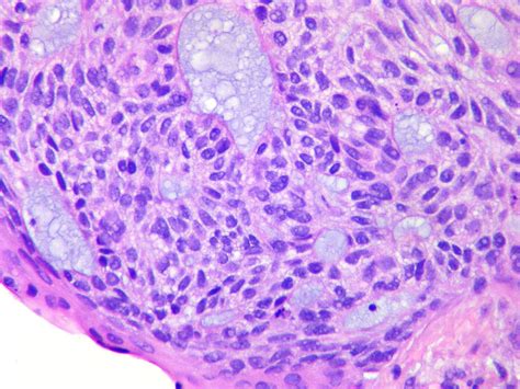 Basaloid Squamous Cell Carcinoma Case 275 Biopsy Tumor Cel Flickr