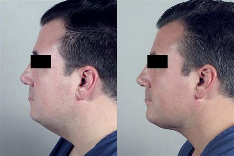 Male Neck Liposuction New Jersey Parker Center For Plastic Surgery
