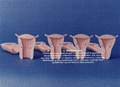 progression of cervical dilatation medical exhibit