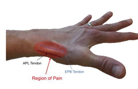 Wrist Tendonitis Surgery