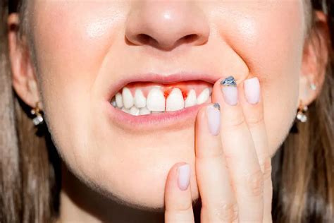 Bleeding Gums And How They Affect Dental Health Arden Dental Center