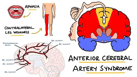 Anterior Cerebral Artery Stroke Effects My Xxx Hot Girl