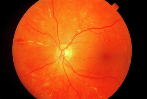 Ophthalmoscopy Of Retinal Embolism In Patient Eye Photograph By Sue