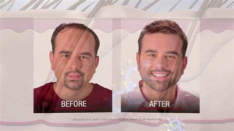 To create the recipe of the food supplement, as many as 13 ingredients were used that inhibit baldness, support hair growth, and have a positive effect on the condition of the scalp, creating the perfect environment for new hair growth.importantly, all the ingredients used to create the tablets are safe for the body and do not cause side effects. DHT Dihydrotestosterone & Hair Loss - YouTube