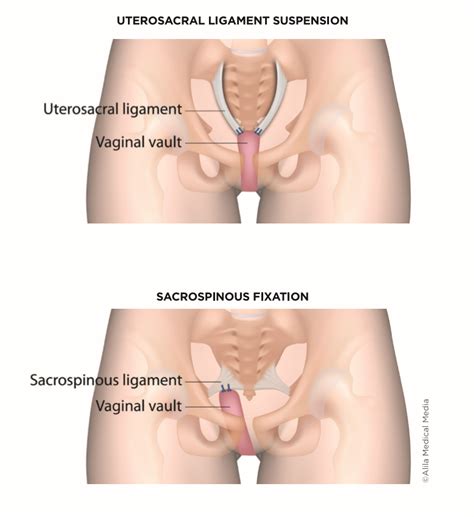 Rectocele Before And After