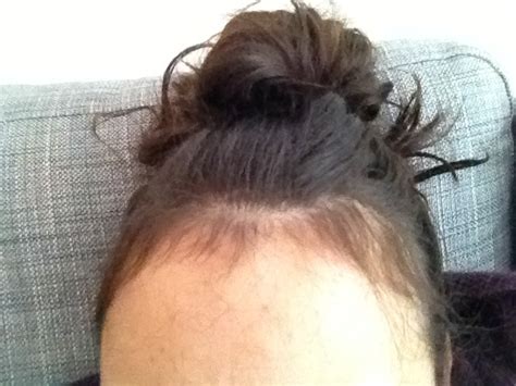 Hair loss is a benign problem. Reality of being a Yummy Mummy: Baby hairs after Pregnancy