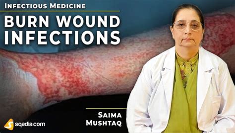 Burn Wound Infections Infectious Medicine Lecture
