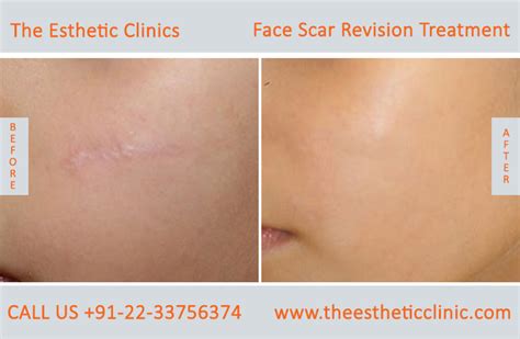 Scars Removal Surgery Cost Renew Physical Therapy