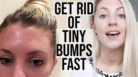 How To Get Rid Of Tiny Bumps On Your Face Youtube