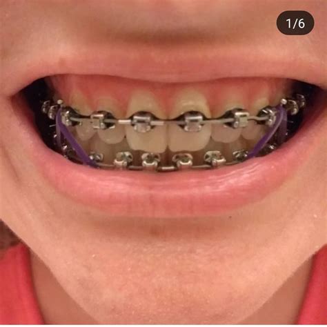 Pin von John Beeson auf Orthodontic Braces Zahnspange Zähne