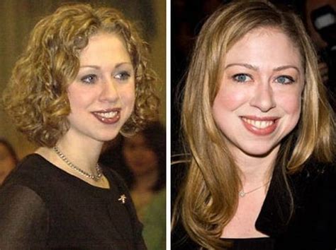 Chelsea Clinton before and after plastic surgery (11 ...