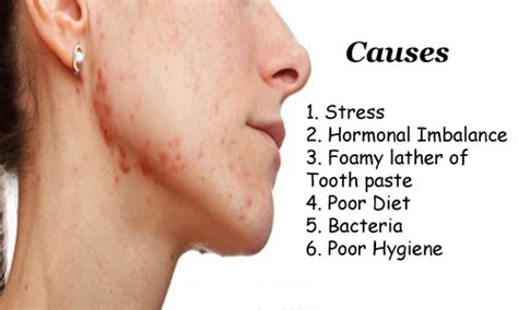 Pin On Hormonal Acne Causes