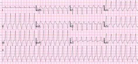 Emcrit Idiopathic Ventricular Tachycardias For The Em Physician By H