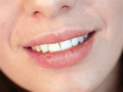 What To Do When You Have Rashes On Your Upper Lip