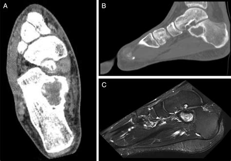 Treatment Of Unicameral Bone Cysts Of The Calcaneus A Systematic