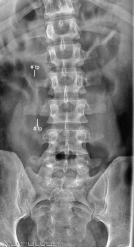 Lumbar Spine Radiography WikiRadiography