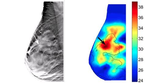 Pet scan for breast cancer. Optical imaging could lead to fewer unnecessary biopsies ...